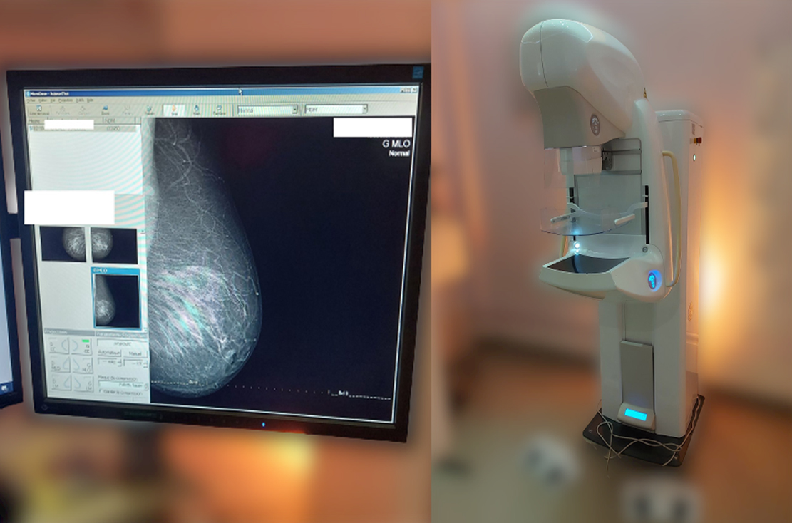 mammography